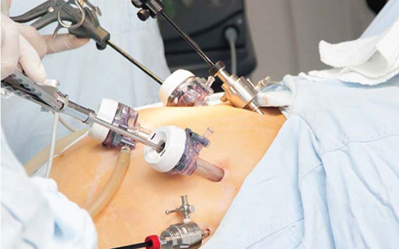 Laparoscopic Surgeries
